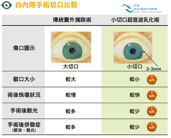 標準白內障手術(人工小切口) | 白內障| 諾貝爾眼科機構診療項目